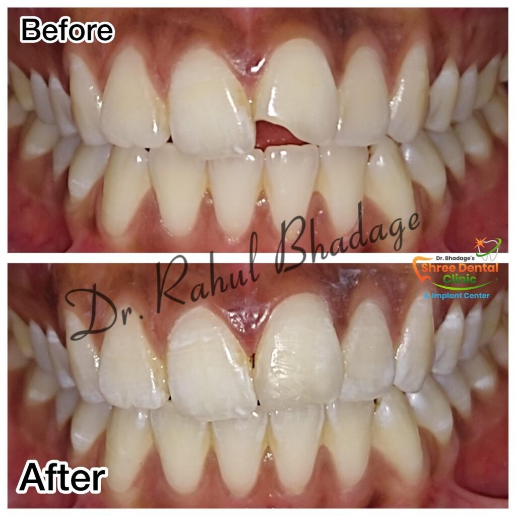 Before and after dental treatment at Shree Dental Clinic, Nashik (case 01)