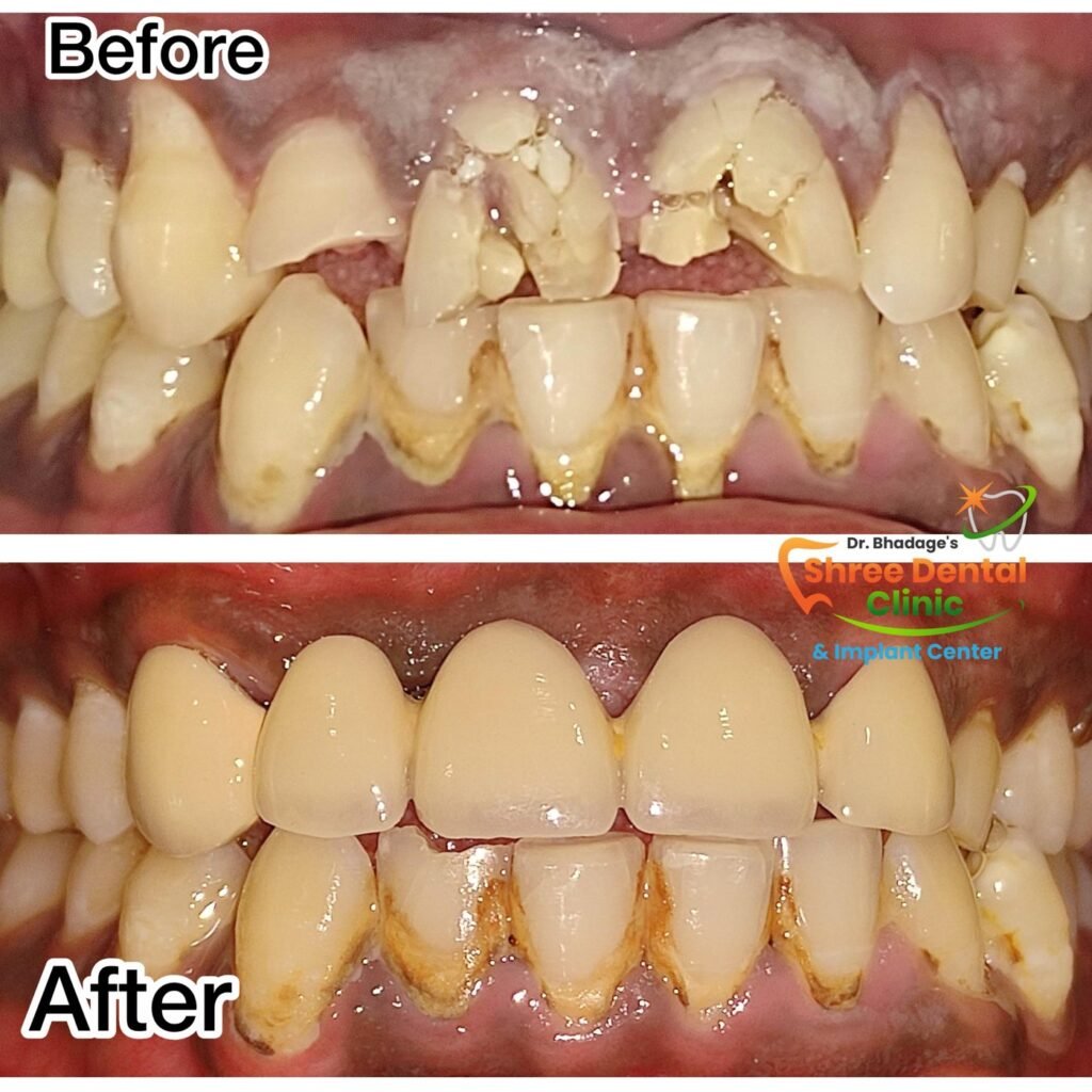 Before and after dental treatment at Shree Dental Clinic, Nashik (case 02)