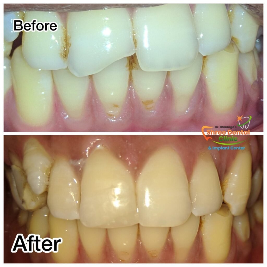 Before and after dental treatment at Shree Dental Clinic, Nashik (case 03)