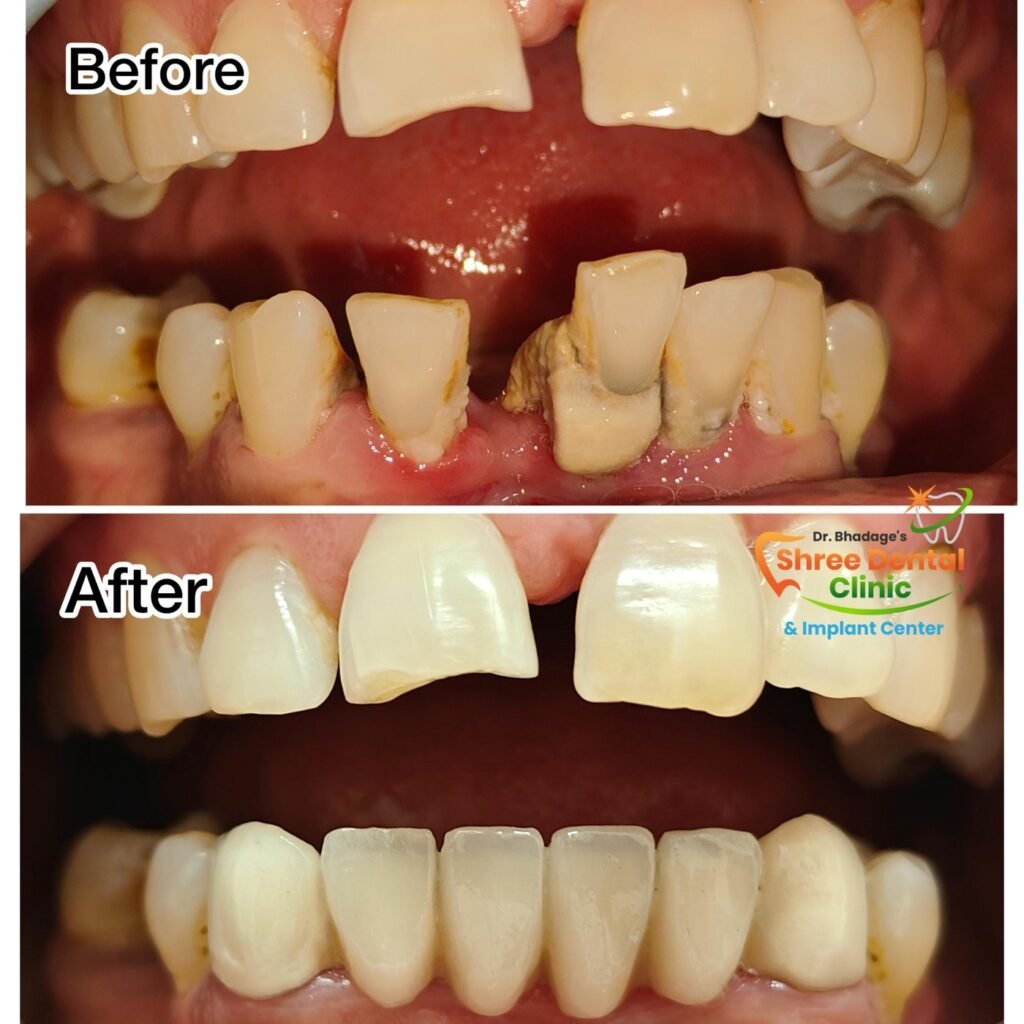 Before and after dental treatment at Shree Dental Clinic, Nashik (case 04)