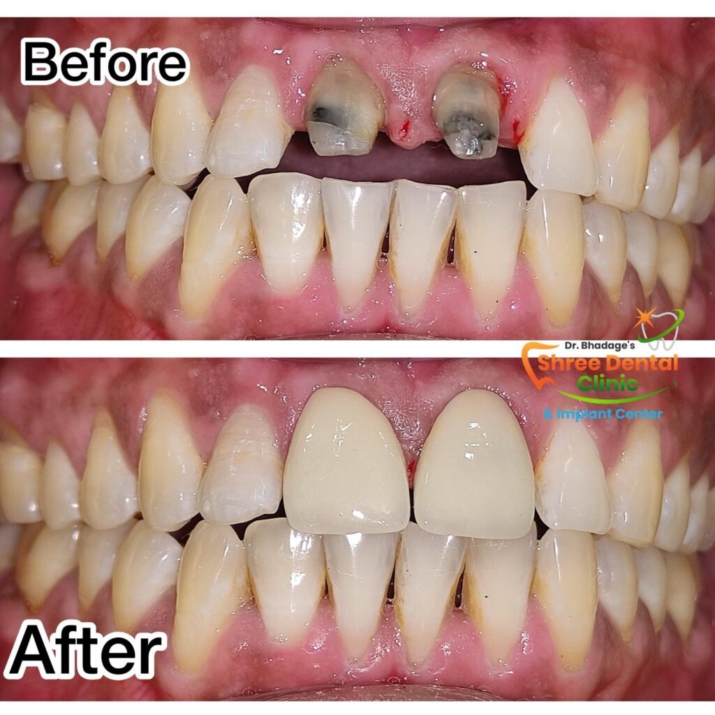 Before and after dental treatment at Shree Dental Clinic, Nashik (case 05)