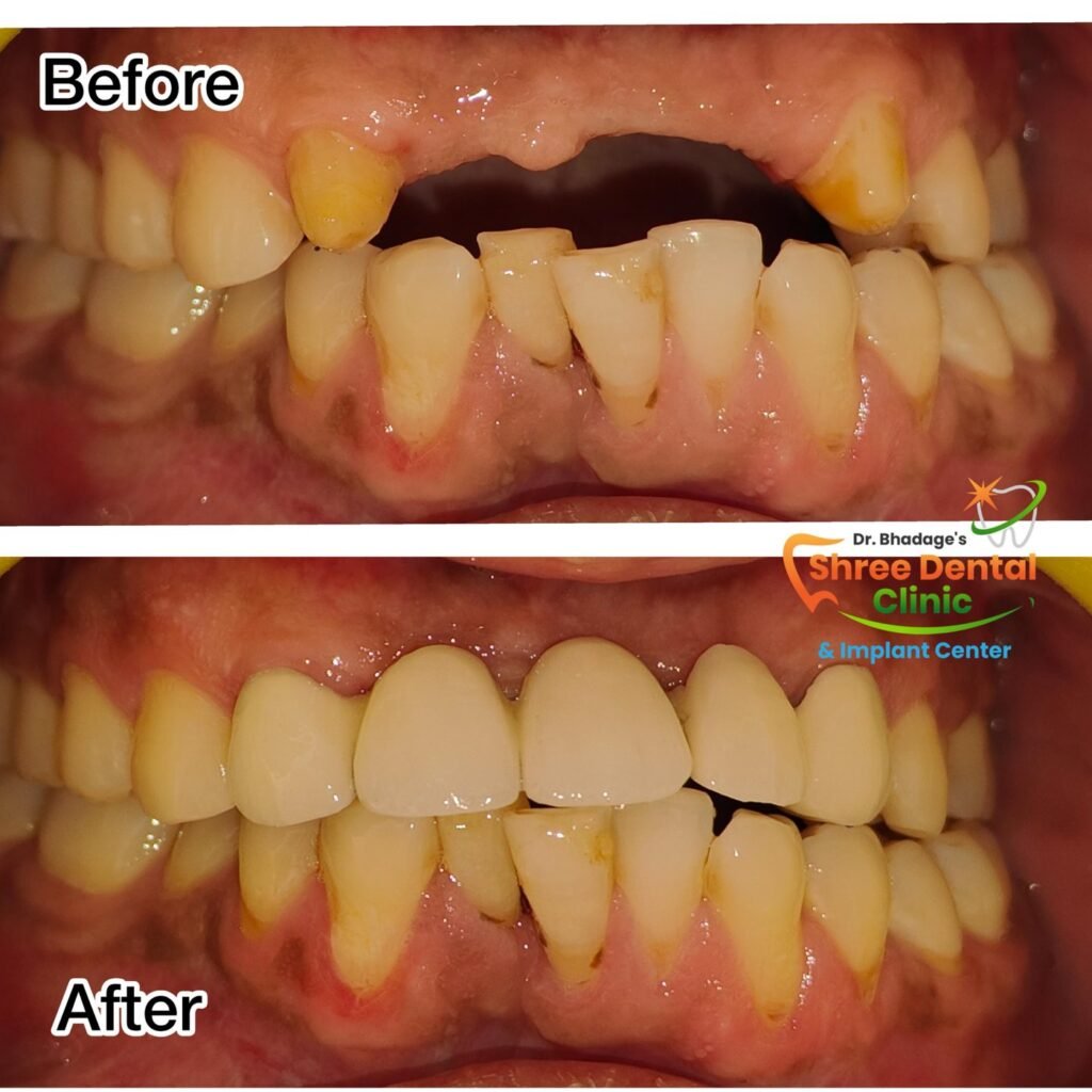 Before and after dental treatment at Shree Dental Clinic, Nashik (case 06)