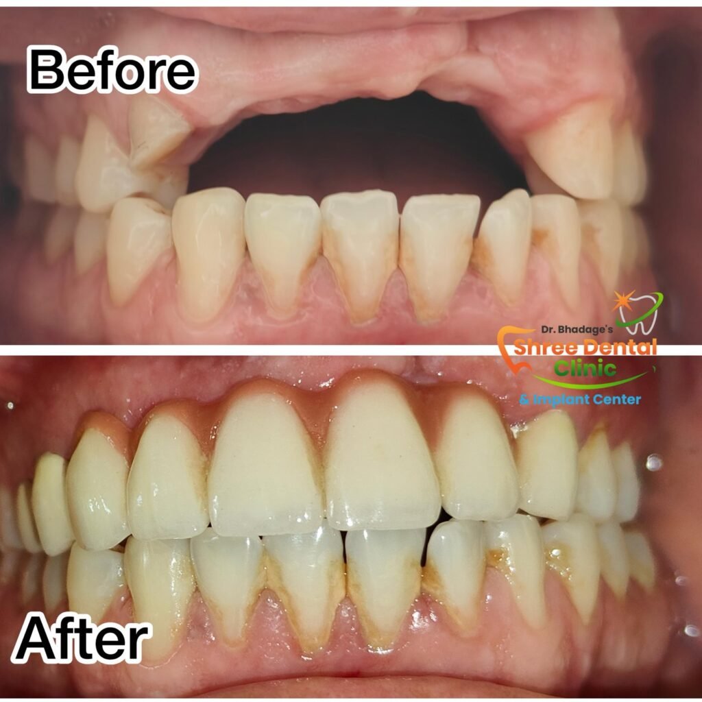 Before and after dental treatment at Shree Dental Clinic, Nashik (case 07)