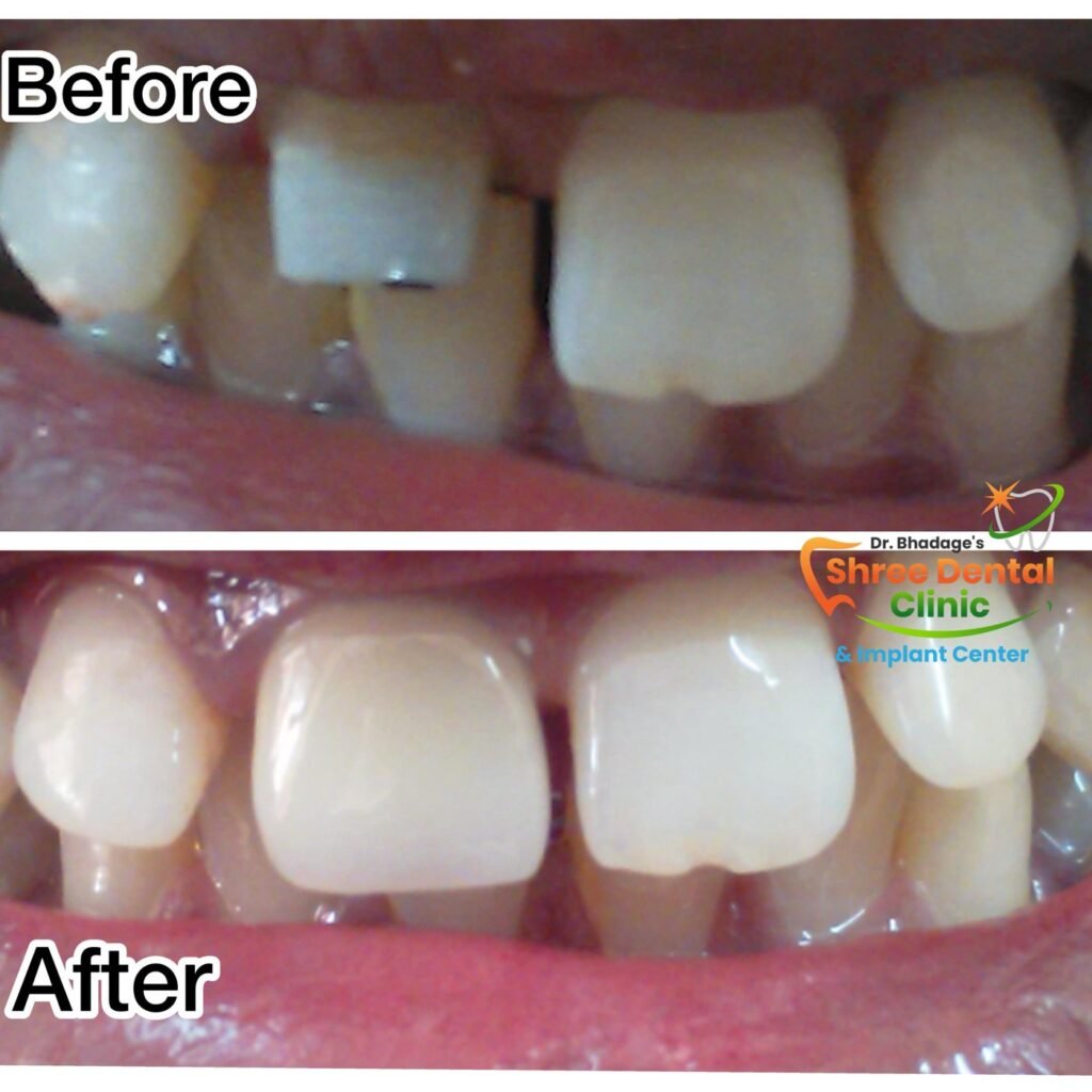 Before and after dental treatment at Shree Dental Clinic, Nashik (case 08)