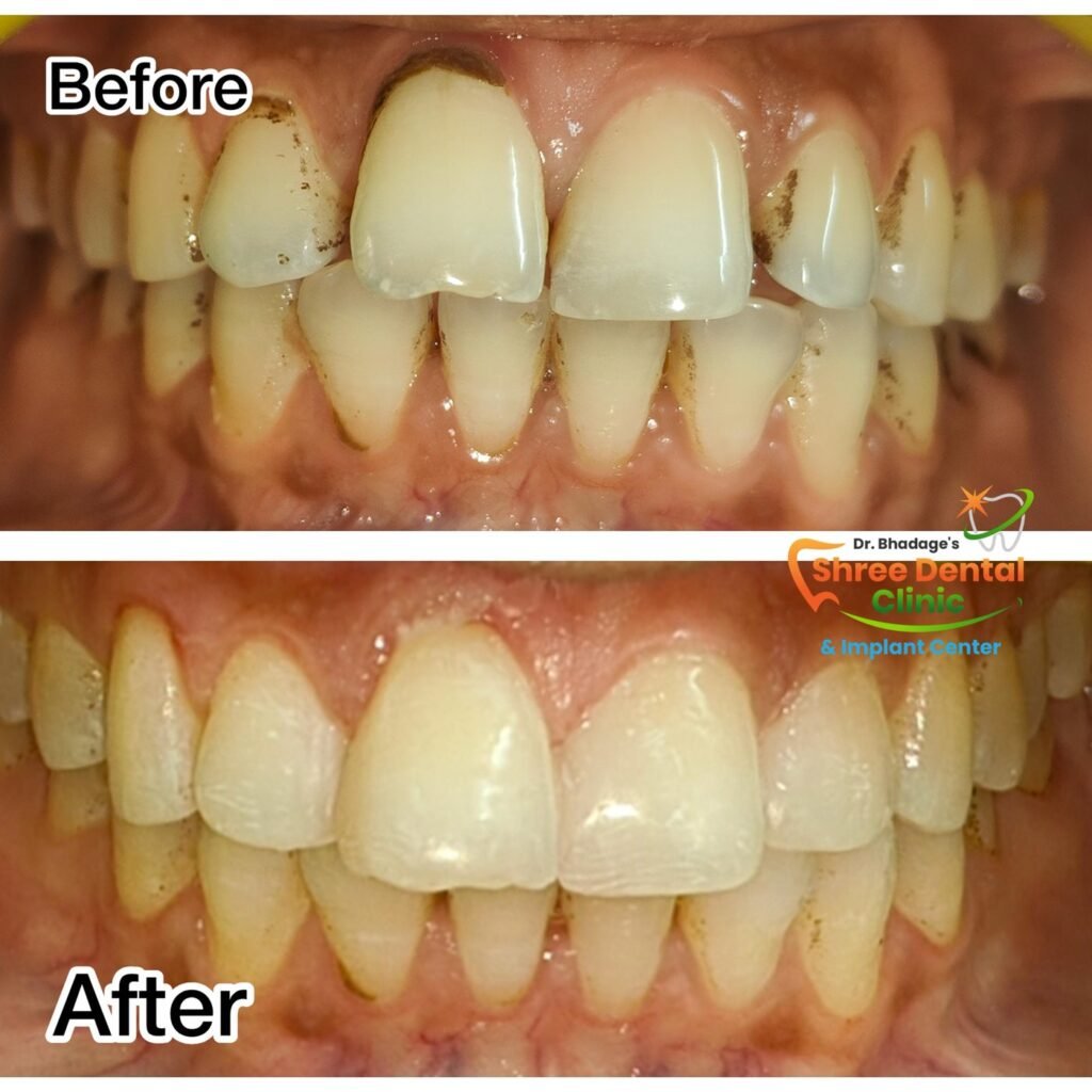 Before and after dental treatment at Shree Dental Clinic, Nashik (case 09)