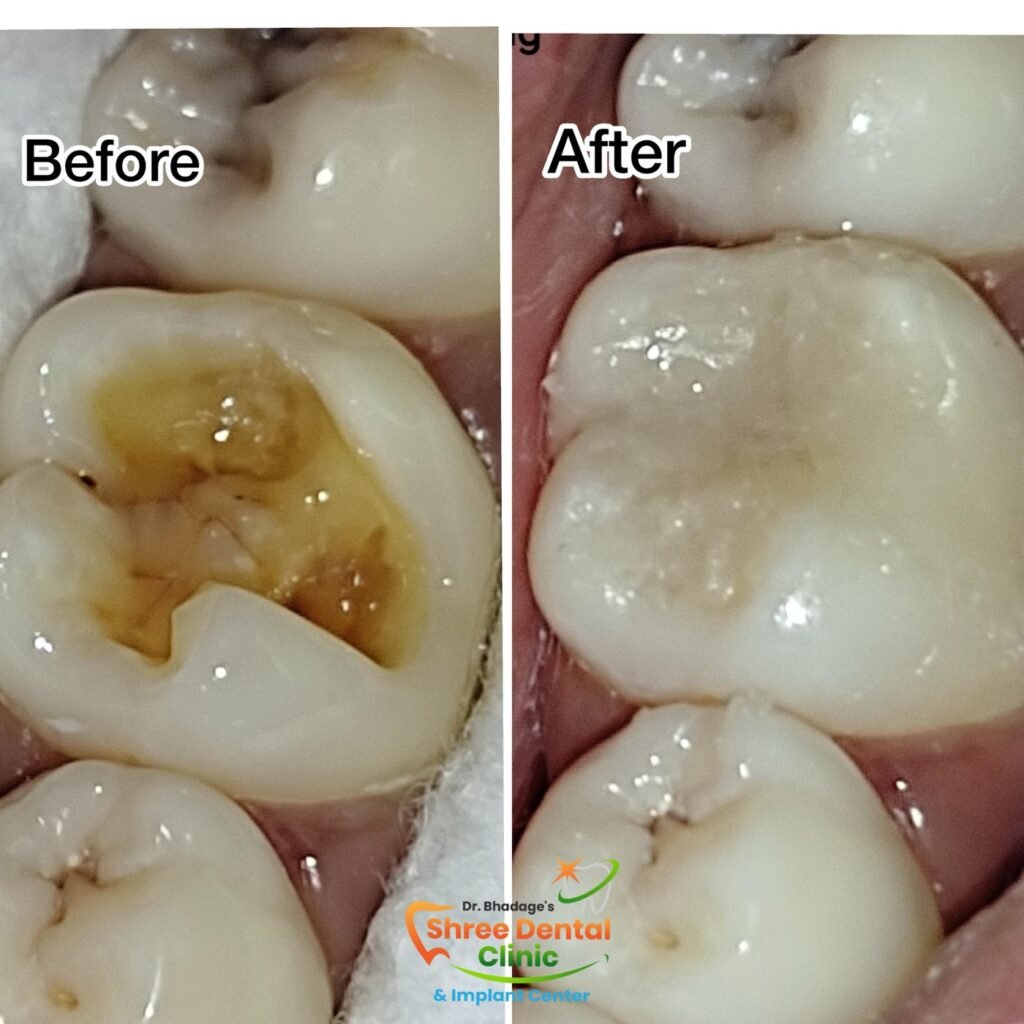Before and after dental treatment at Shree Dental Clinic, Nashik (case 10)