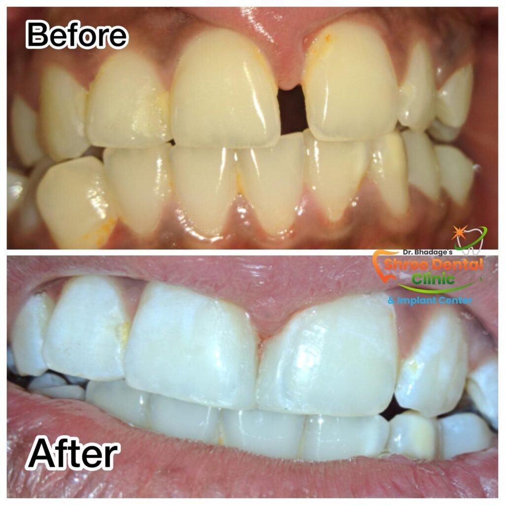 Before and after dental treatment at Shree Dental Clinic, Nashik (case 11)