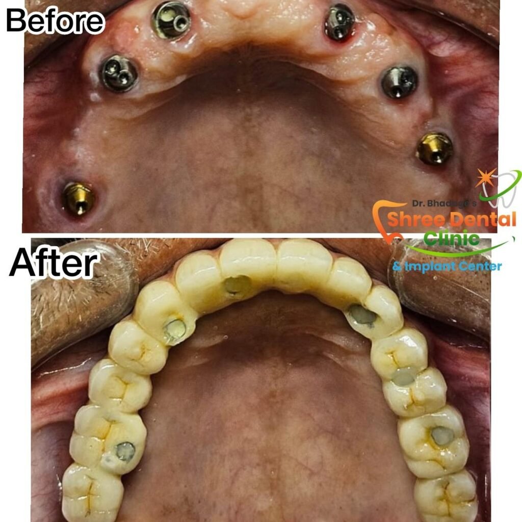 Before and after dental treatment at Shree Dental Clinic, Nashik (case 12)