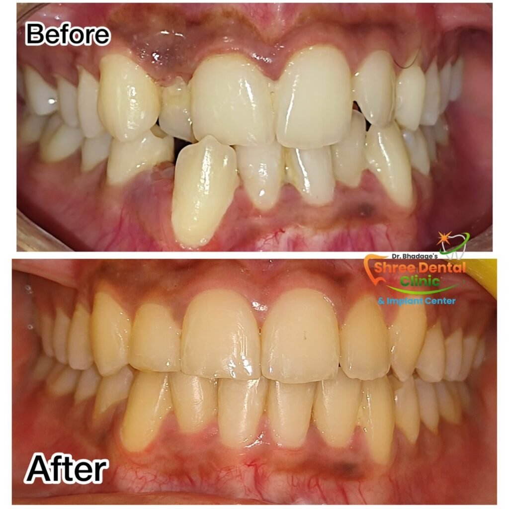 Before and after dental treatment at Shree Dental Clinic, Nashik (case 13)