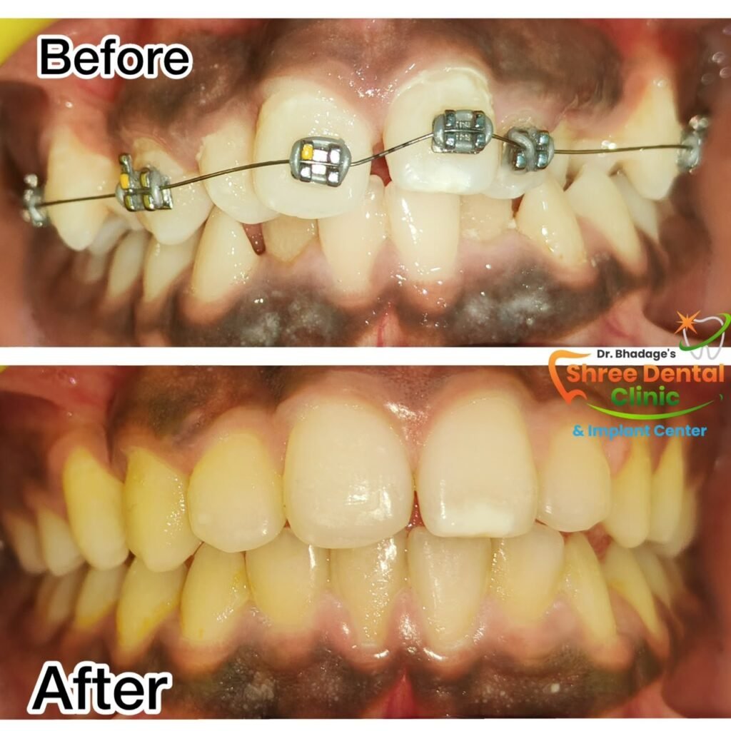Before and after dental treatment at Shree Dental Clinic, Nashik (case 14)