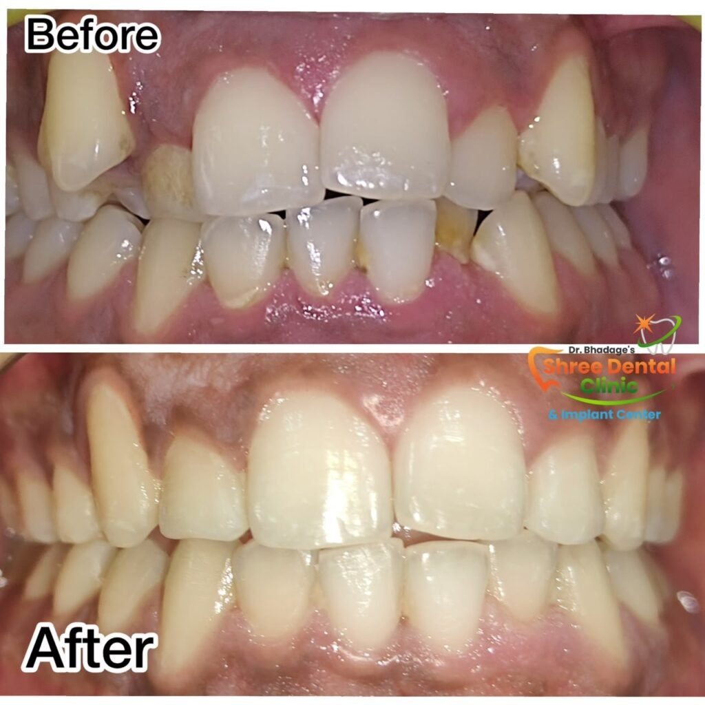 Before and after dental treatment at Shree Dental Clinic, Nashik (case 15)